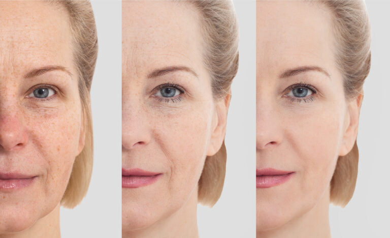 What Are the Best Ways to Reduce Wrinkles?