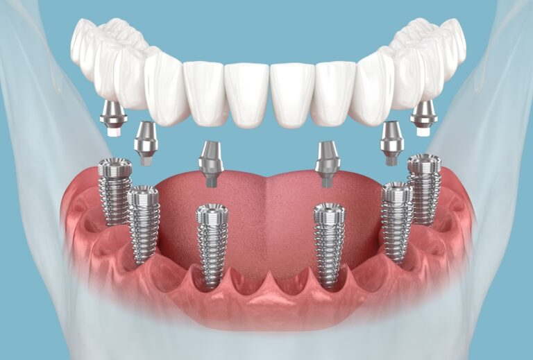 All About Dental Implants